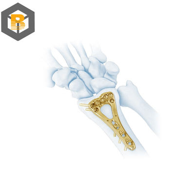 Parcela de usinagem de precisão CNC para benefício da placa de bloqueio de pluma de raio distal multi-axial